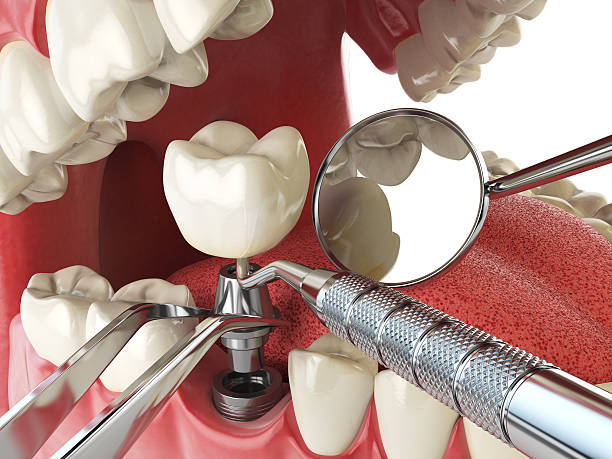 Best Broken or Cracked Tooth Emergency Dentist in Allendale, CA